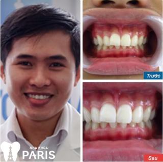 Khách hàng trước và sau khi tẩy trắng răng nha khoa paris - Ảnh 1