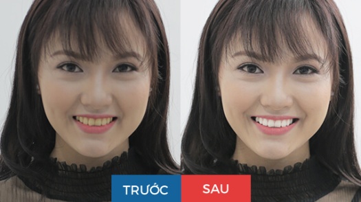 Hình ảnh trước và sau tẩy trắng răng tại Nha khoa Paris