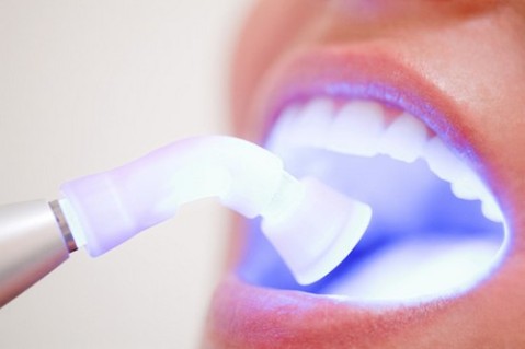 Tẩy trắng răng bằng đèn plasma có hại không – Giải đáp từ bác sĩ Paris