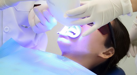 Tẩy trắng răng laser là cách chữa răng nhiễm fluor nhẹ