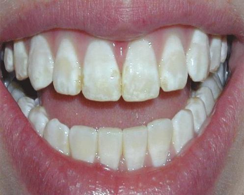 Răng nhiễm fluor thường có xuất hiện đốm trắng trên răng
